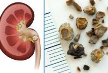 Hangi bitki böbrek taşını eritir? Böbrek taşı en hızlı nasıl düşer?