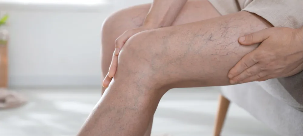 Varis tedavisi nedir? Varis nasıl geçer?