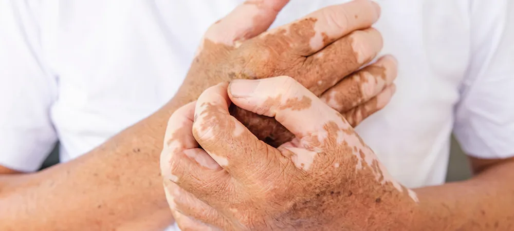 Vitiligo nedir? Vitiligo belirtileri, nedenleri ve tedavi seçenekleri
